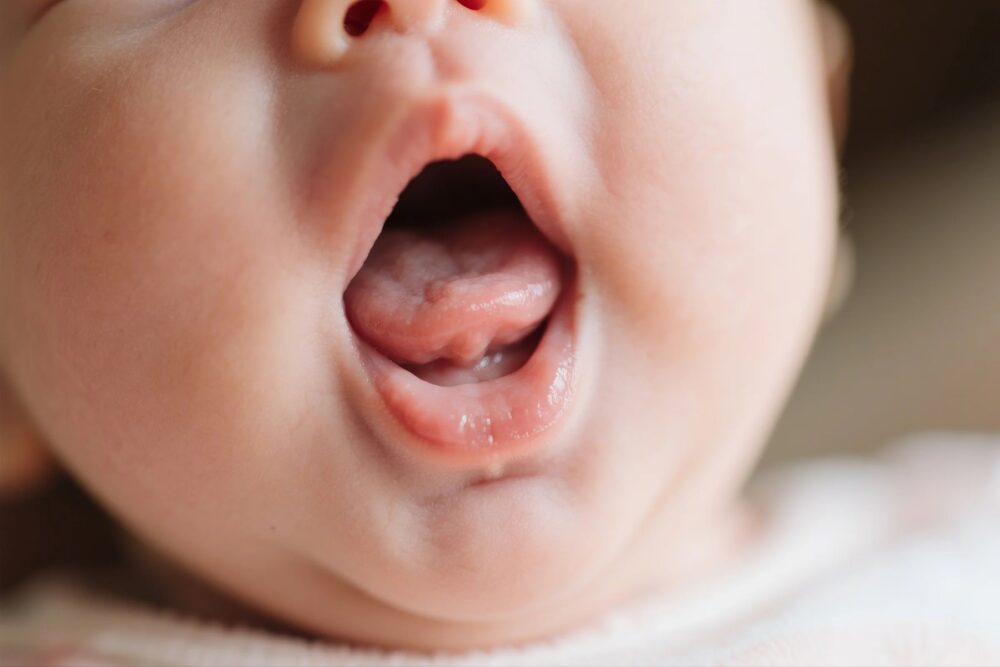 What Is Tongue Tie? What Is Tongue Tie?
